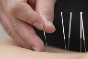 back pain &acupuncture