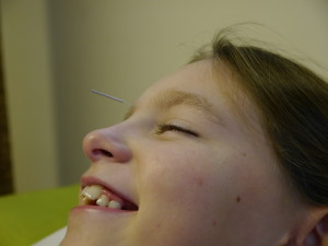 asthma treated with acupuncture