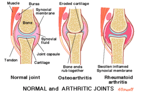 arthritis treated with acupuncture